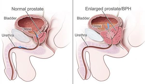eiaculazione 2 farmajet