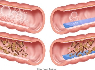 meteorismo-e-flatulenza-400x296