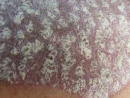 psoriasi8