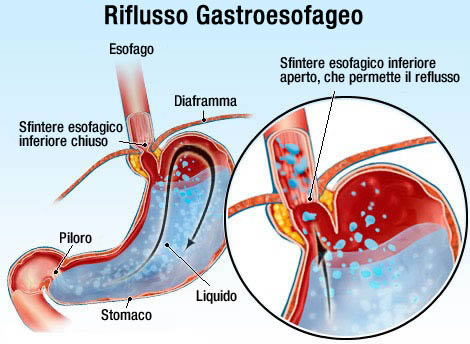 reflusso-gastroesofageo farmajet