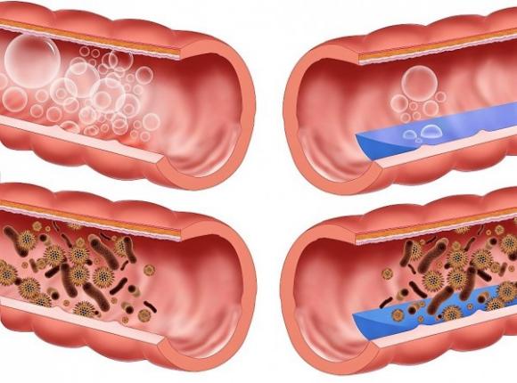 Meteorismo-intestinale2-