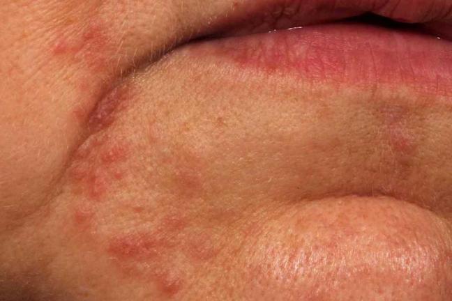 dermatite alla bocca