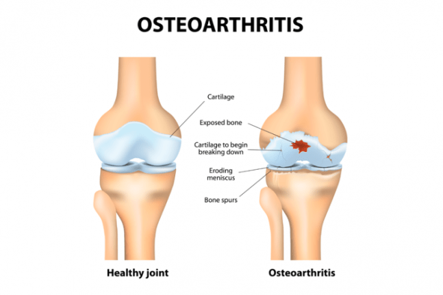 osteoartrite farmajet.png