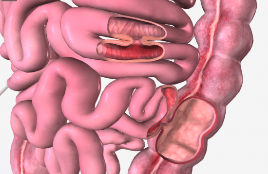 fistola intestinale.png